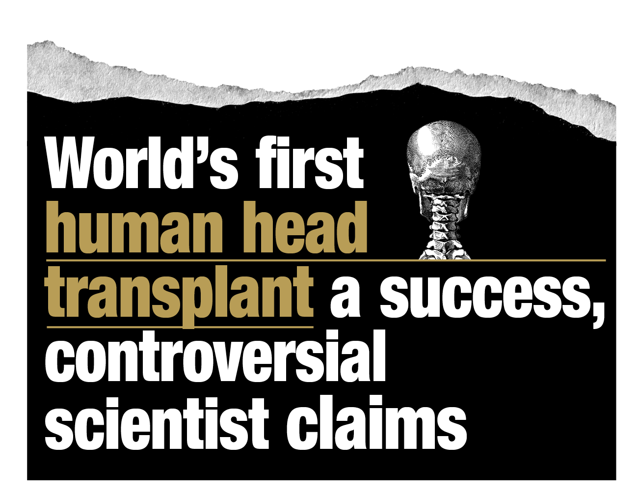 World's first human head transplant a success, controversial scientist claims